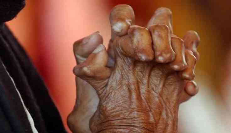 LEPROSY: THE MISFORTUNE OF THE COMMANDER-IN-CHIEF OF THE ARMED FORCES