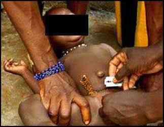 FGM